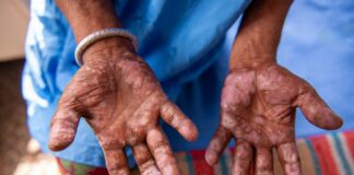 ŠOKANTNO: Gobavost se vrača v Evropo — potrjeni primeri na Hrvaškem in v Romuniji!