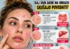 akne na obrazu, chat gpt